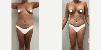 Case 175 - Woman treated with Tummy Tuck