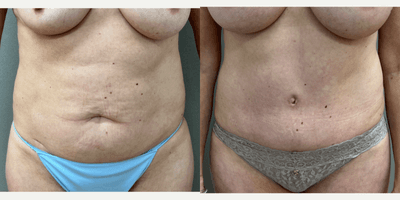 Case 182 - 48 year old woman treated with Tummy Tuck