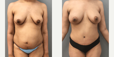 Case 1829 - 25-34 year old woman treated with Tummy Tuck