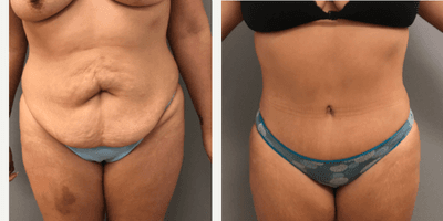 Case 1838 - 35-44 year old woman treated with Tummy Tuck