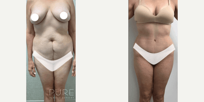 Case 186 - Woman treated with Tummy Tuck