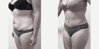 Case 1876 - Woman treated with Tummy Tuck