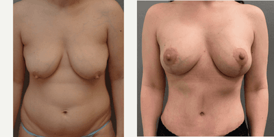 Case 2098 - 35-44 year old woman treated with Tummy Tuck