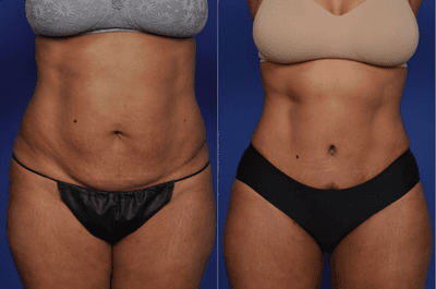 Case 2118 - Tummy Tuck