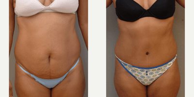 Case 2120 - 35-44 year old woman treated with Tummy Tuck