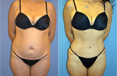 Case 2124 - 35-44 year old woman treated with Tummy Tuck