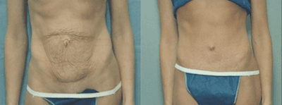 Case 2126 - 35-44 year old woman treated with Tummy Tuck