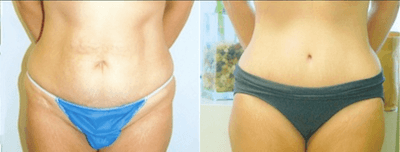 Case 2127 - 35-44 year old woman treated with Tummy Tuck