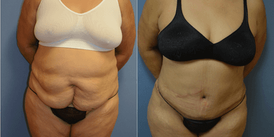 Case 2128 - 35-44 year old woman treated with Tummy Tuck