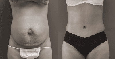 Case 2157 -  Tummy Tuck