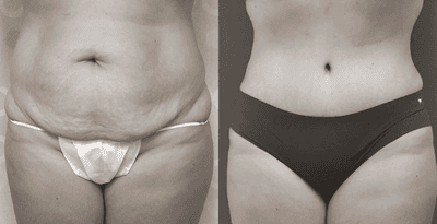 Case 2158 - Tummy Tuck