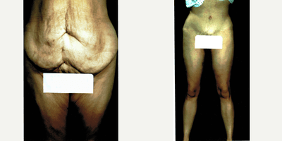 Case 2166 - 35-44 year old woman treated with Tummy Tuck