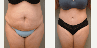 Case 2167 - 35-44 year old woman treated with Tummy Tuck