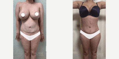 Case 217 - Woman treated with Tummy Tuck