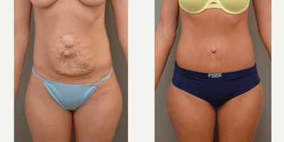 Case 2171 - 35-44 year old woman treated with Tummy Tuck