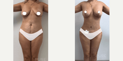 Case 218 - Woman treated with Tummy Tuck