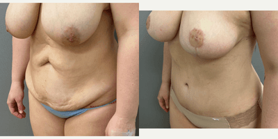 Case 2188 - 25-34 year old woman treated with Tummy Tuck