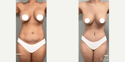 Case 219 - Woman treated with Tummy Tuck 