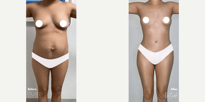 Case 220 - Woman treated with Tummy Tuck