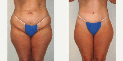 Case 2286 - 45-54 year old woman treated with Tummy Tuck