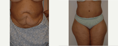 Case 2292 - 45-54 year old woman treated with Tummy Tuck