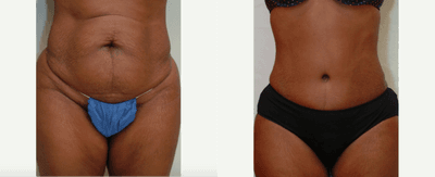 Case 2294 - 35-44 year old woman treated with Tummy Tuck