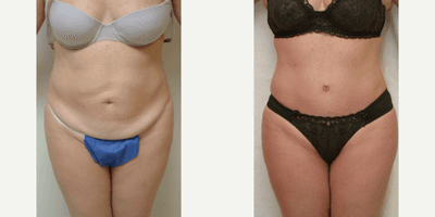 Case 2295 - 45-54 year old woman treated with Tummy Tuck