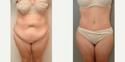 Case 2296 - 45-54 year old woman treated with Tummy Tuck