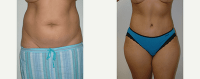 Case 2297 - 25-34 year old woman treated with Mommy Makeover