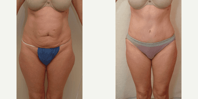 Case 2298 - 35-44 year old woman treated with Tummy Tuck