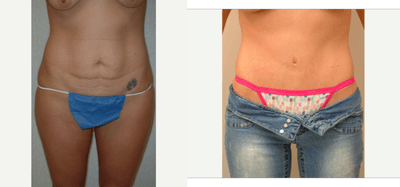 Case 2299 - 25-34 year old woman treated with Mommy Makeover