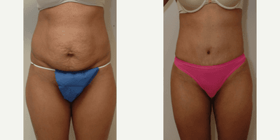 Case 2300 - 25-34 year old woman treated with Tummy Tuck
