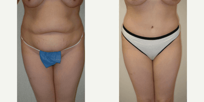 Case 2301 - 25-34 year old woman treated with Tummy Tuck