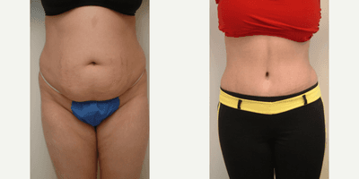 Case 2302 - 35-44 year old woman treated with Tummy Tuck