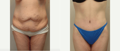 Case 2304 - 35-44 year old woman treated with Tummy Tuck