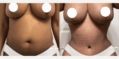 Case 242 - Woman treated with Tummy Tuck