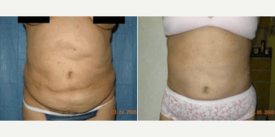 Case 243 - Woman treated with Tummy Tuck