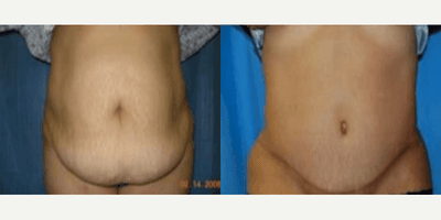 Case 244 - Woman treated with Tummy Tuck