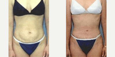 Case 245 - Woman treated with Tummy Tuck