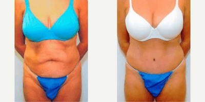 Case 246 - Woman treated with Tummy Tuck