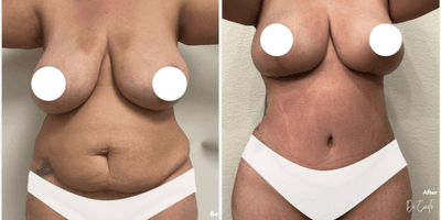 Case 258 - Woman treated with Tummy Tuck