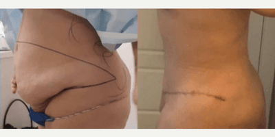 Case 2582 - Woman treated with Tummy Tuck