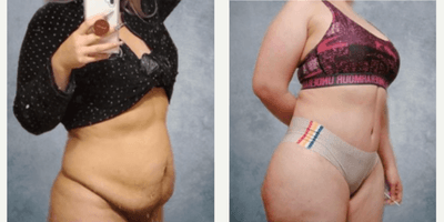 Case 2631 - Woman treated with Tummy Tuck