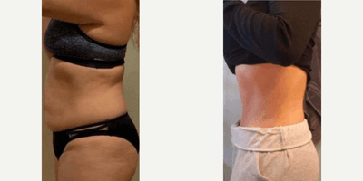 Case 2632 - Woman treated with Tummy Tuck