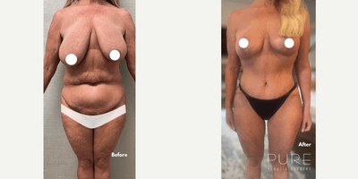 Case 265 - Woman treated with Tummy Tuck