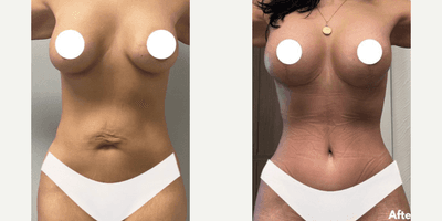 Case 266 - Woman treated with Tummy Tuck