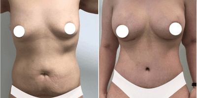 Case 267 - Woman treated with Tummy Tuck