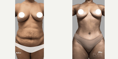 Case 274 - Woman treated with Tummy Tuck
