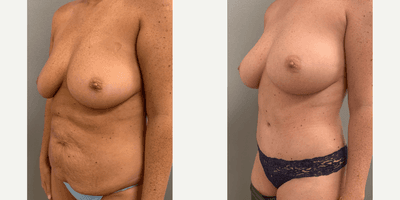 Case 2823 - 25-34 year old woman treated with Tummy Tuck