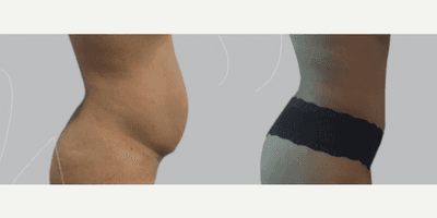 Case 2873 - Woman treated with Tummy Tuck